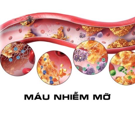 Máu nhiễm mỡ là gì