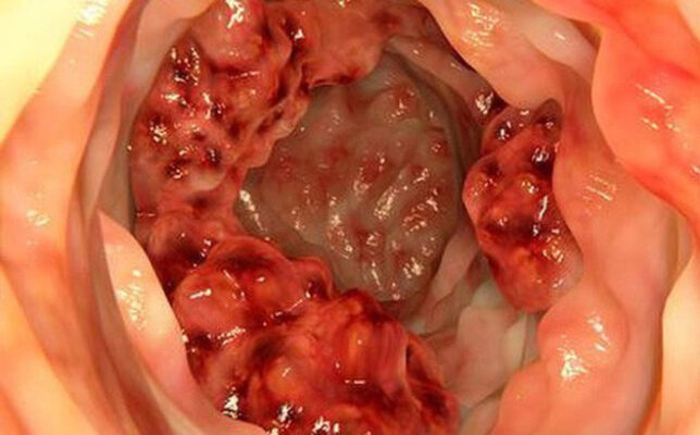 Ung Thư đại tràng