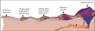 Các giai đoạn phát triển bệnh ung thư