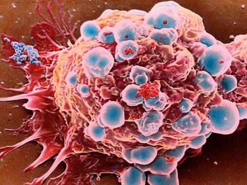 Sự hình thành khối u ung thư