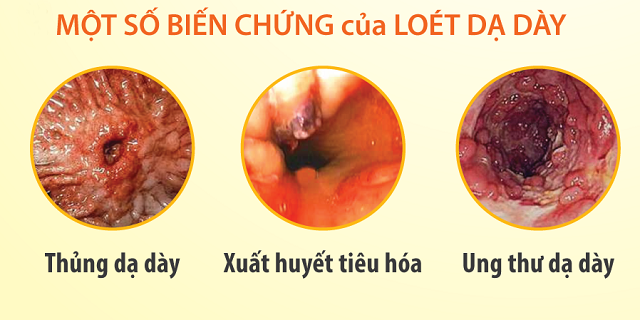 Bệnh viêm loét dạ dày