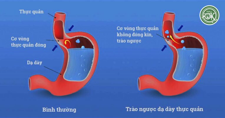 Bệnh trào ngược axit dạ dày